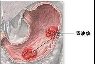 消化性溃疡的症状有哪些？如何用药物治疗