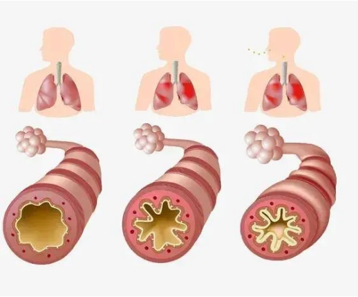 急性支气管炎危害大吗?主要症状有哪些