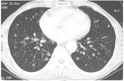 CT-肺癌知识点考核：55岁男性，结肠癌术后2年